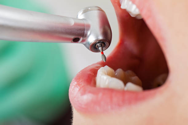 Best Emergency Dentist for Lost Fillings or Crowns in , PA